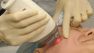 Πώς γίνεται η κλασματική ανανέωση του δέρματος