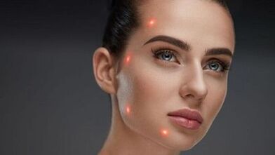 Τι είναι η κλασματική αναζωογόνηση του δέρματος