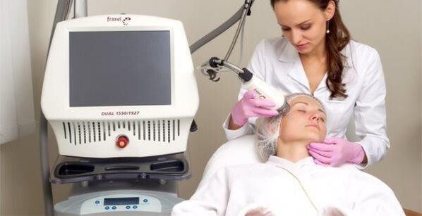 Fractional laser ανανέωση δέρματος