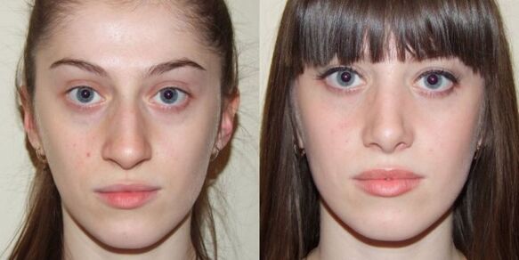 Κορίτσι πριν και μετά την ανανέωση δέρματος προσώπου με πλάσμα